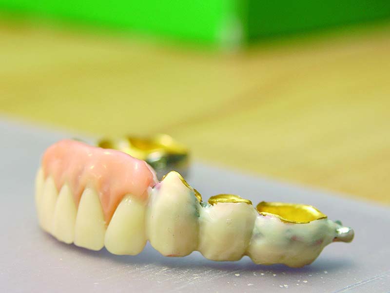 Der Zahnersatz ist eingegliedert - Nachsorge und Komplikationsmanagement