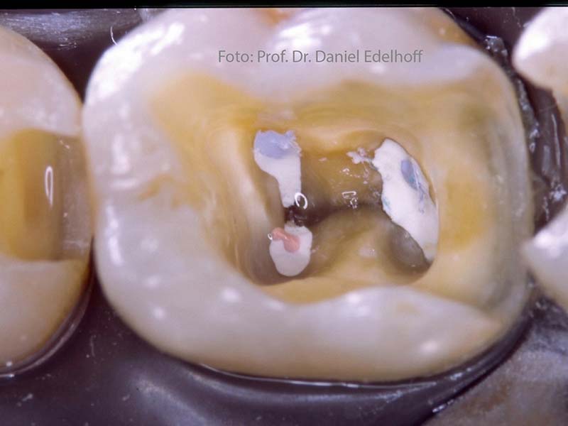 Postendodontischer Aufbau von Zähnen in der festsitzenden Prothetik